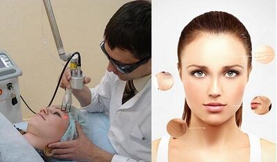 Теринин лазердик жашаруусу кандай жүргүзүлөт